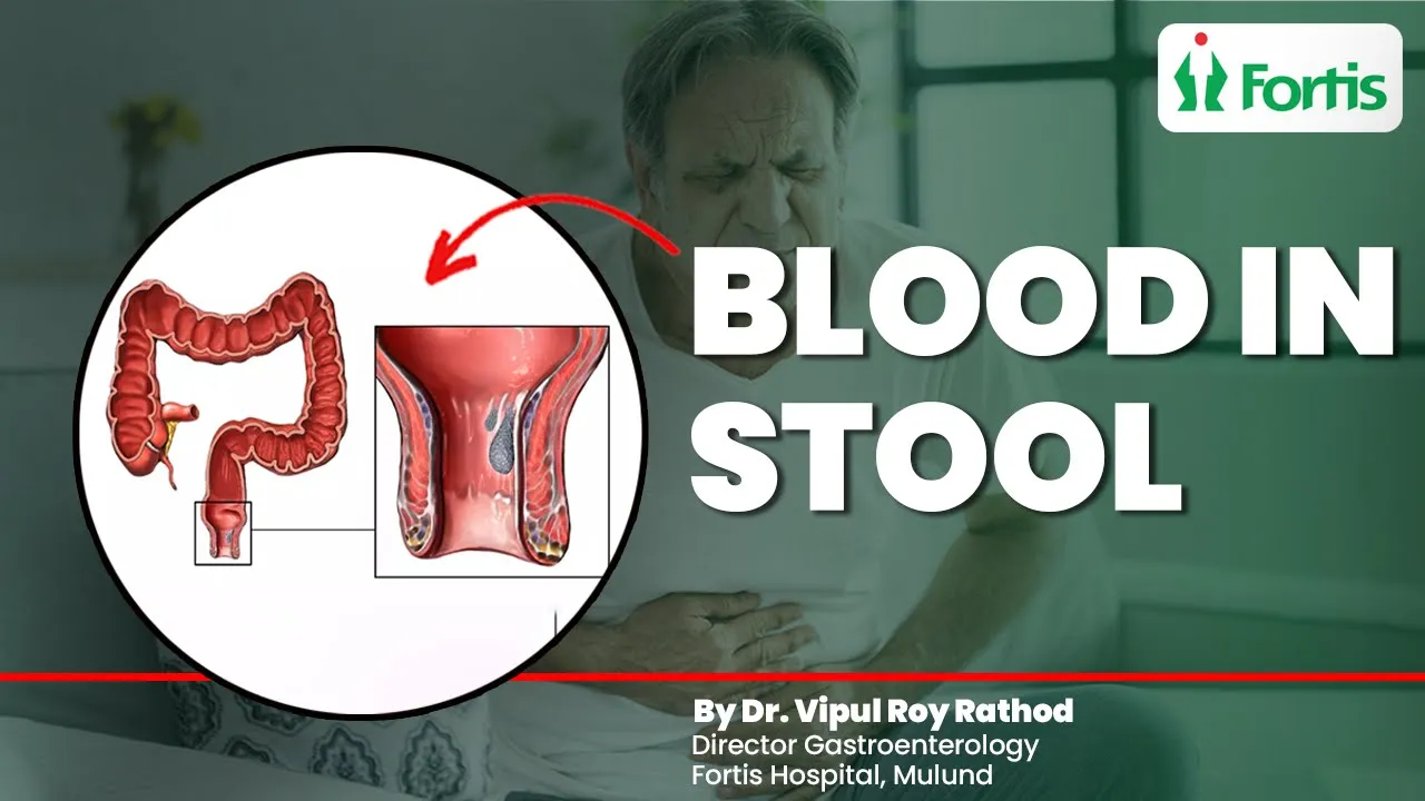 Blood In Stool Causes and Treatment 