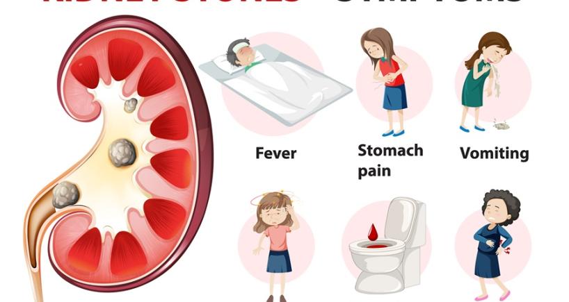 Kidney Stone Treatment