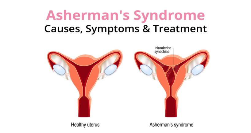 Deciphering Asherman’s Syndrome