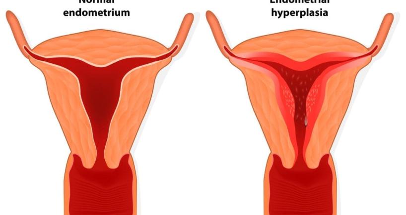 Exploring Congenital Adrenal Hyperplasia: