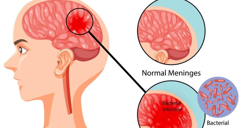 Meningitis Symptoms in Adults