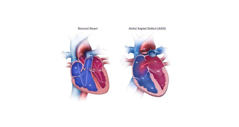 Atrial Septal Defects (ASD)