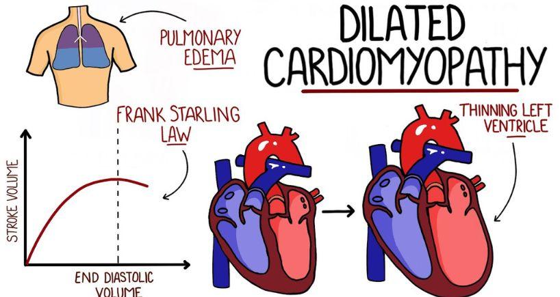 Dilated Cardiomyopathy