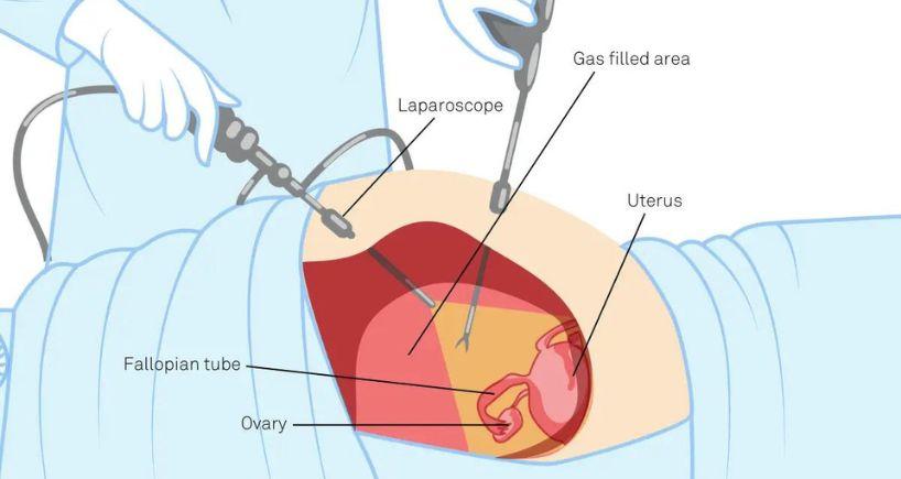 Invasive Gynaecological Procedures