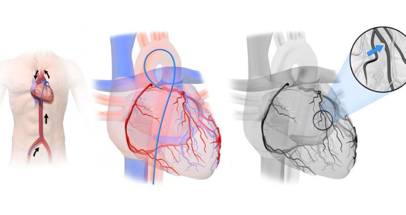 Cardiac Catheterisation