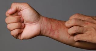 Demystifying Eczema: Symptoms, Causes, Types, and Treatments