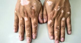 Vitiligo Overview: Symptoms, Causes, Types, and Risks