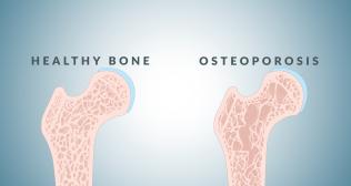 Osteoporosis