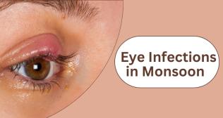 How to Prevent Monsoon Eye Infections