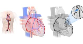 Cardiac Catheterisation Explained