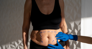 Liposuction