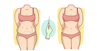 Tummy Tuck