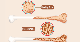 strategies to improve bone density 