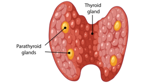 Fibromuscular Dysplasia