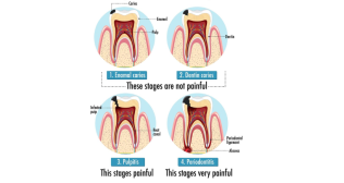 Root Canal Treatment