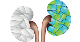 Understanding Your Kidneys: Transplantation Facts | Fortis Health ...