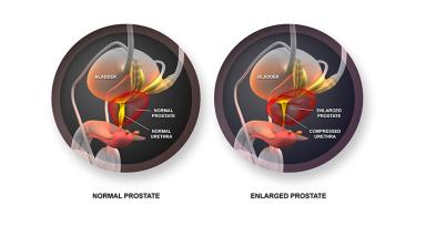 Advantages Of  Benign Prostate Enlargement