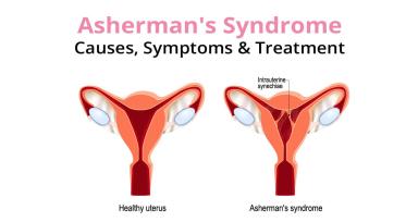 Deciphering Asherman’s Syndrome