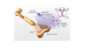 Multiple Myeloma