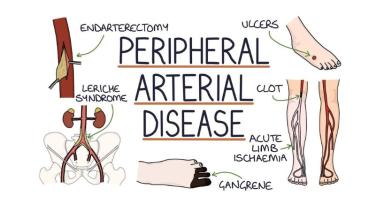 Peripheral Artery Disease (PAD)