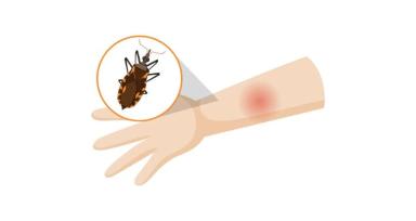 Chagas Disease