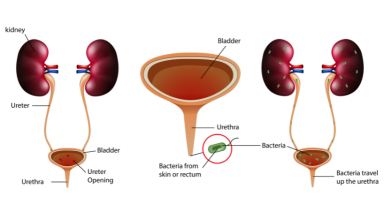 Causes and Symptoms of Melena