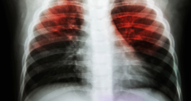 Tuberculosis is in the air