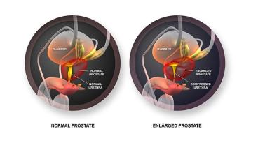 UroLift